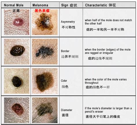 胸上的痣|痣也可能会癌变！长在 3 个地方要注意